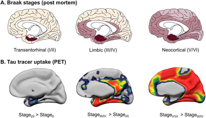 Figure 3. Braak stages of tau pathology in Alzheimer’s disease and their in vivo PET correlates.